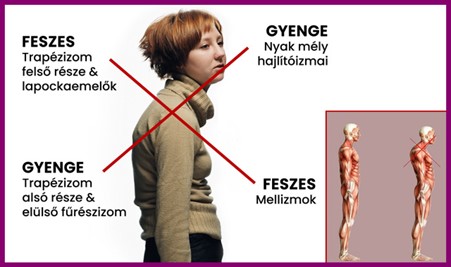 Read more about the article Felső keresztezett szindróma